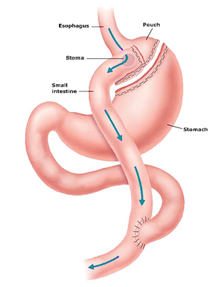 Gastric Bypass Illustration